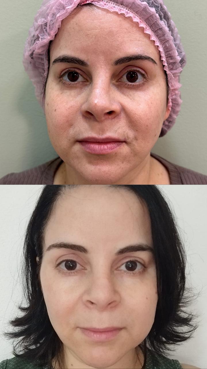 Resultado real de Bioestimulador realizado pela RN Clínica — registro 1