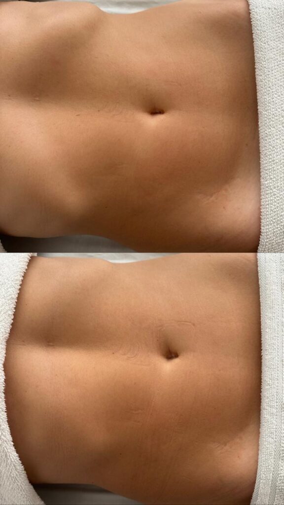 Antes e depois de drenagem corporal na RN Clínica