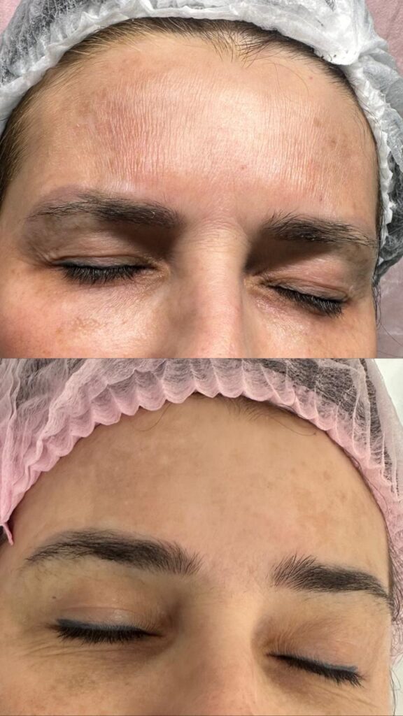 Antes e depois de jato de plasma na RN Clínica