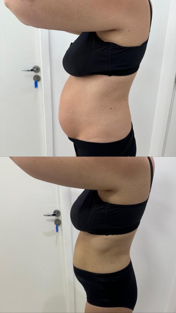 Antes e depois de tratamento de diástase na RN Clínica