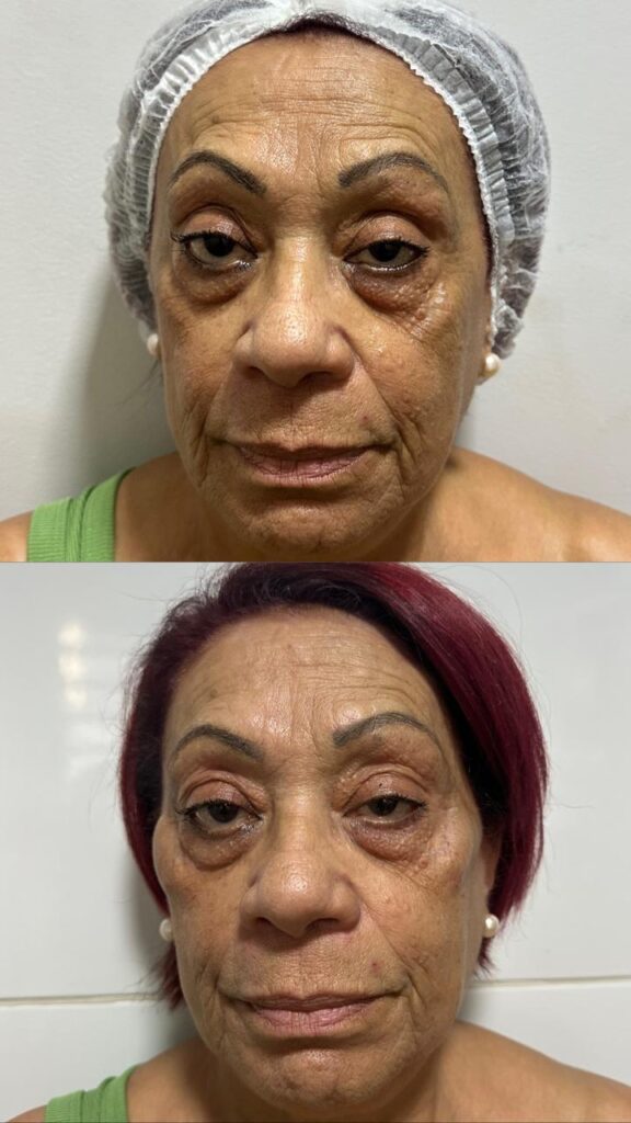 Registro de antes e depois de cuidado facial realizado pela RN Clínica